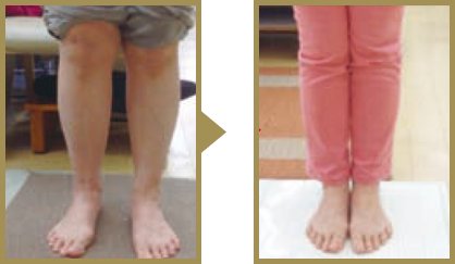 X脚と変型性膝関節症の M.N さん(52歳 女性)