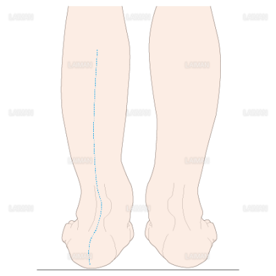 下腿のアライメント 踵部外反 ｓサイズ Laiman Stockweb メディカルイラスト素材のダウンロード販売