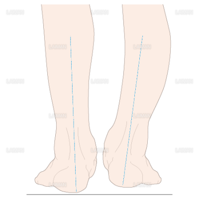 下腿のアライメント 踵部内反 ｍサイズ Laiman Stockweb メディカルイラスト素材のダウンロード販売