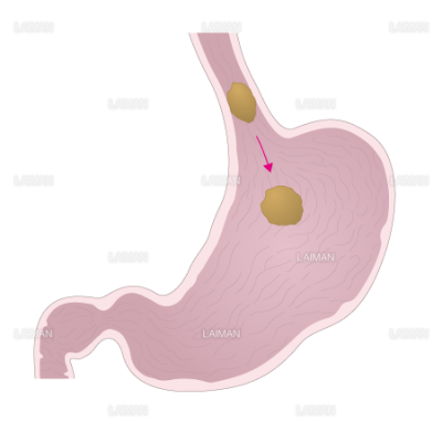 下部食道括約筋の動き２ ｍサイズ Laiman Stockweb メディカルイラスト素材のダウンロード販売