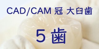 CAD/CAM冠 大臼歯 完成まで ５歯