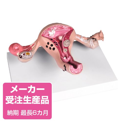 予約販売】子宮モデル病変付き - 京都科学オンラインショップ