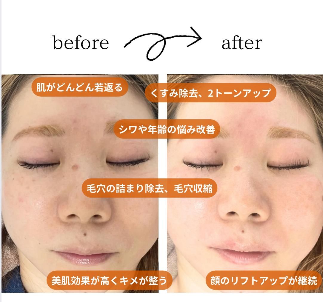beforeafter